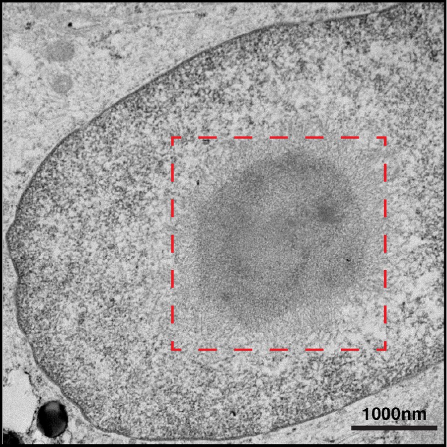 Electron micrograph of an intranuclear inclusion